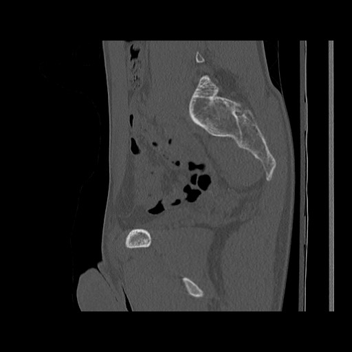 Normal pelvis (Radiopaedia 51473-57238 Sagittal bone window 59).jpg