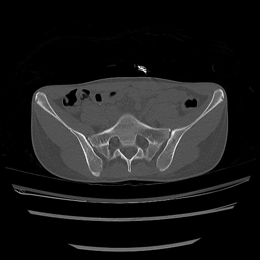 Normal pelvis CT (Radiopaedia 51471-57236 Axial bone window 27).jpg
