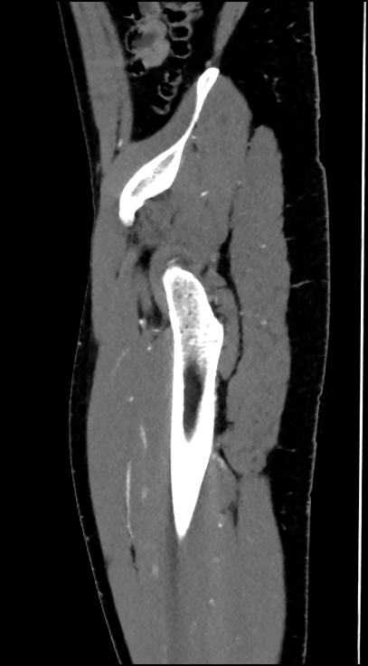 Normal pelvis CT angiogram (Radiopaedia 84966-100481 C 92).jpg