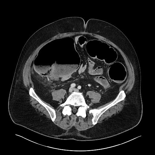 Obstructing sigmoid adenocarcinoma (Radiopaedia 58465-65619 A 111).jpg