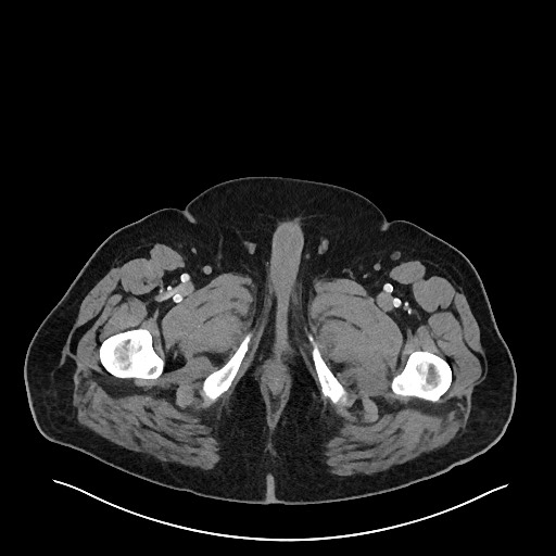 Obstructing sigmoid adenocarcinoma (Radiopaedia 58465-65619 A 177).jpg