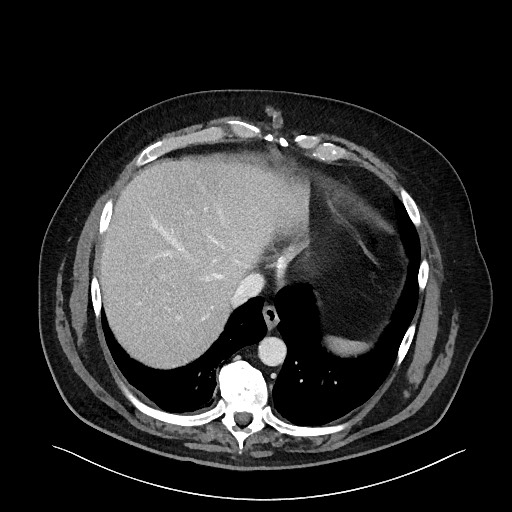 File:Obstructing sigmoid adenocarcinoma (Radiopaedia 58465-65619 A 24).jpg