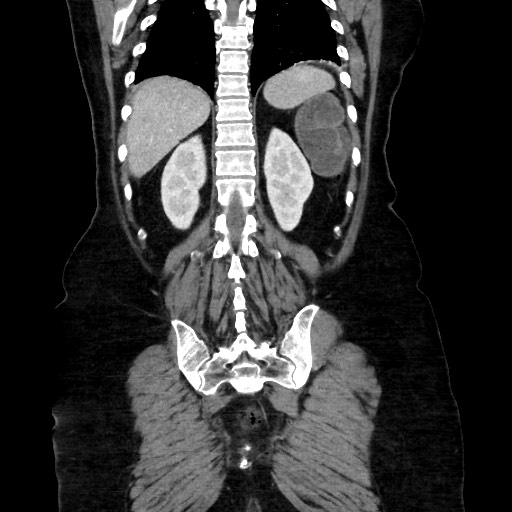 Obstructive distal colonic adenocarcinoma causing cecal perforation (Radiopaedia 86830-102989 C 134).jpg
