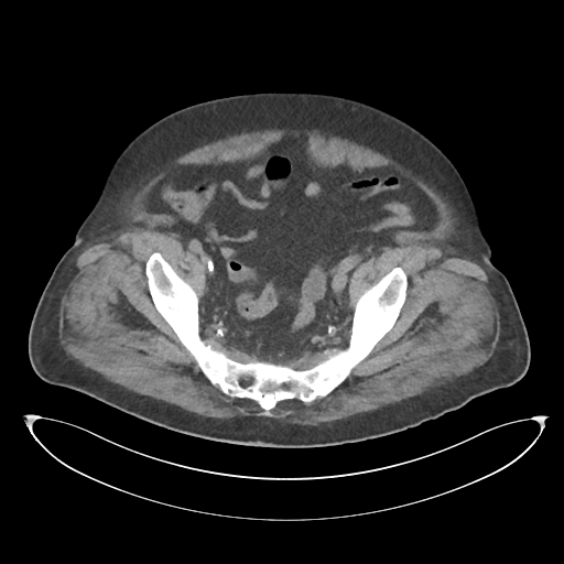 File:Obstructive pyelonephritis (Radiopaedia 46411-50844 Axial non-contrast 66).png