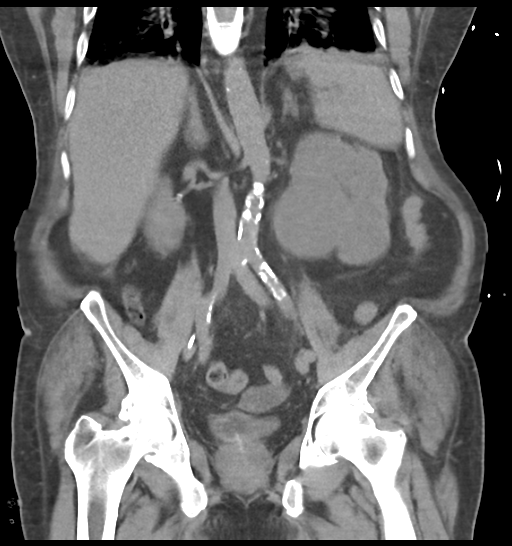 File:Obstructive pyelonephritis (Radiopaedia 46411-50844 Coronal non-contrast 39).png