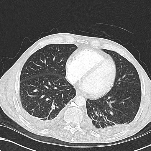 File:Obstructive superior vena cava tumor thrombus (Radiopaedia 28046-28306 Axial lung window 38).jpg