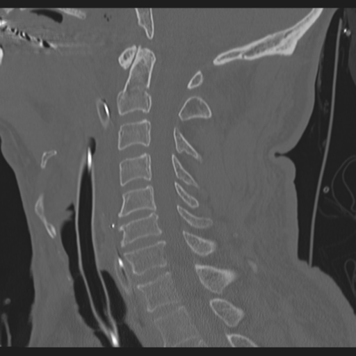 File:Occipital condyle fracture (Radiopaedia 33467-34517 Coronal bone window 1).png