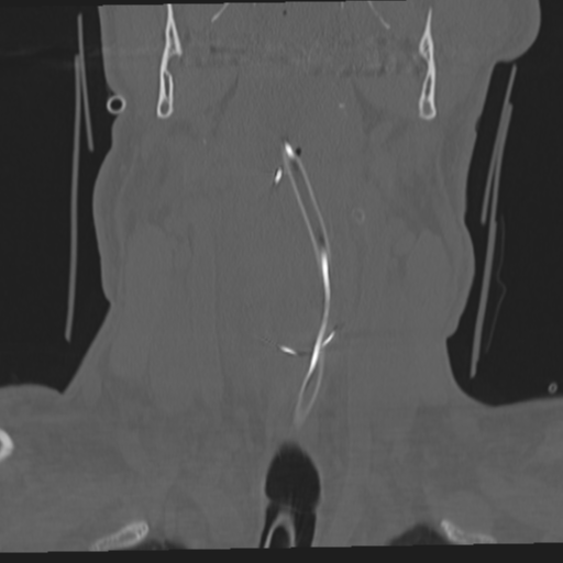 File:Occipital condyle fracture (Radiopaedia 33467-34517 Coronal bone window 13).png