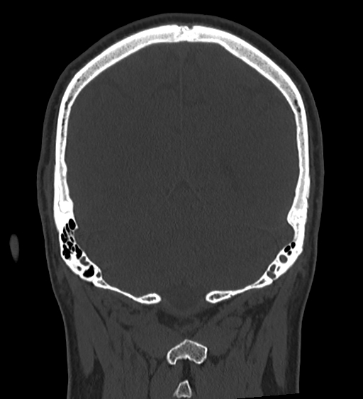 Occipital spur and Currarino type A atlas anomaly (Radiopaedia 87027-103285 Coronal bone window 109).jpg