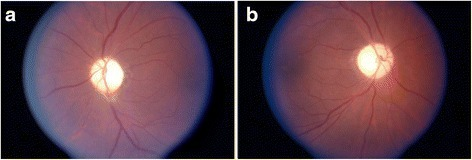Optic atrophy on fundoscopic exam in DRPLA. Very pale optic discs are evident bilaterally. a) OS, and b) OD