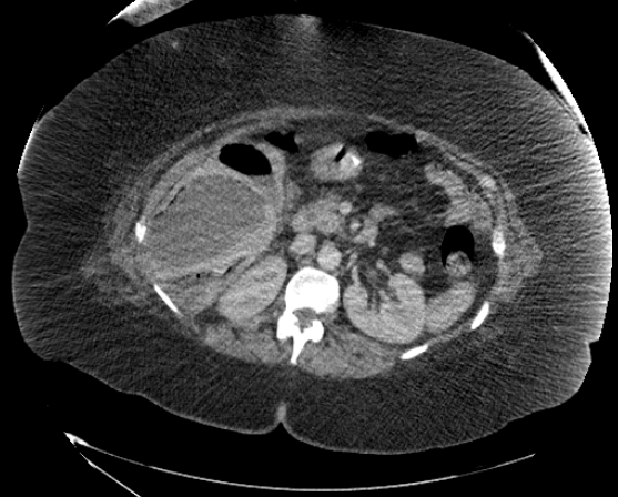 File:Abdominal abscess - pre and post percutaneous drainage (Radiopaedia 60209-67816 Axial 35).png