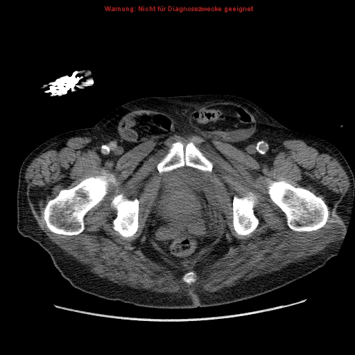 File:Abdominal aortic aneurysm- extremely large, ruptured (Radiopaedia 19882-19921 Axial C+ arterial phase 80).jpg