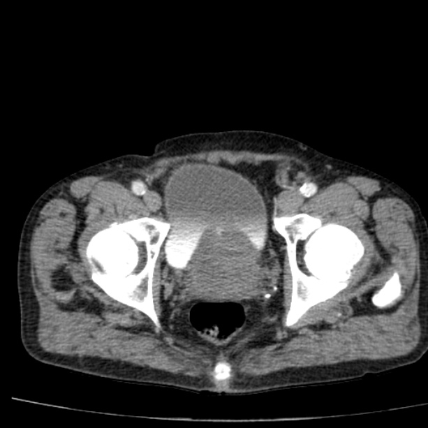 Abdominal aortic aneurysm (Radiopaedia 29248-29660 Axial C+ arterial phase 86).jpg