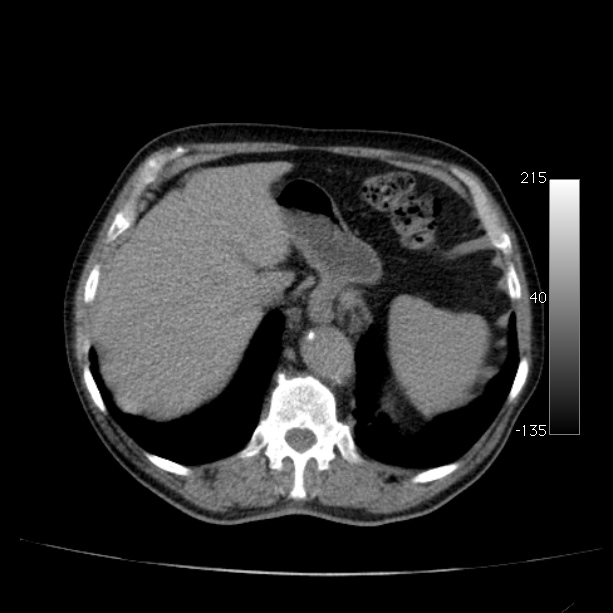 Abdominal aortic aneurysm (Radiopaedia 29248-29660 Axial non-contrast 13).jpg