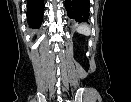 Abdominal aortic aneurysm (Radiopaedia 67117-76452 Coronal C+ arterial phase 98).jpg