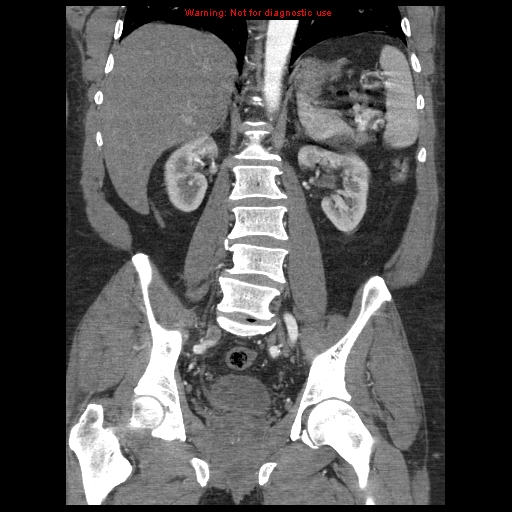 Abdominal aortic aneurysm (Radiopaedia 8190-9038 Coronal C+ arterial phase 81).jpg