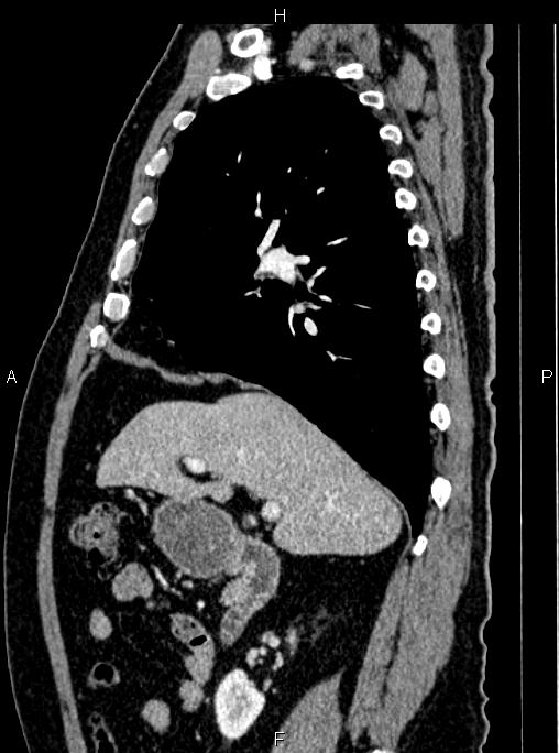 Abdominal aortic aneurysm (Radiopaedia 83094-97462 Sagittal renal cortical phase 46).jpg