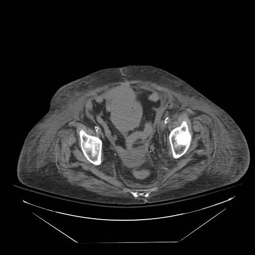 Abdominal aortic aneurysm - impending rupture (Radiopaedia 19233-19247 Axial non-contrast 144).jpg