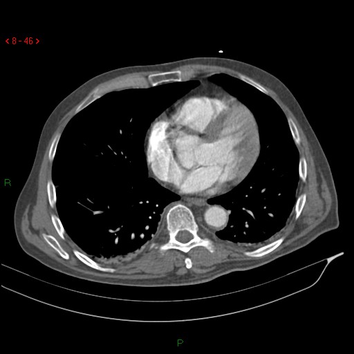 Abdominal aortic aneurysm rupture with aortocaval fistula (Radiopaedia 14897-14841 Axial C+ arterial phase 46).jpg