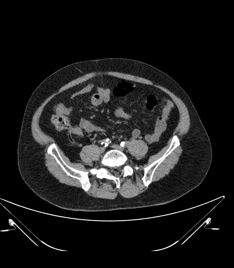 Abdominal aortic aneurysm with thrombus fissuration (Radiopaedia 46218-50618 Axial non-contrast 38).jpg