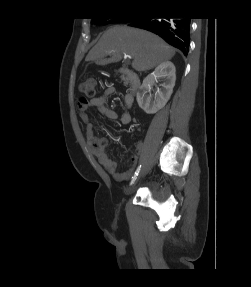 Abdominal aortic aneurysm with thrombus fissuration (Radiopaedia 46218-50618 Sagittal C+ arterial phase 20).jpg