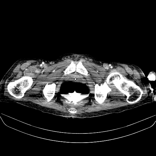 File:Abdominal collection due to previous cecal perforation (Radiopaedia 80831-94320 Axial C+ portal venous phase 211).jpg