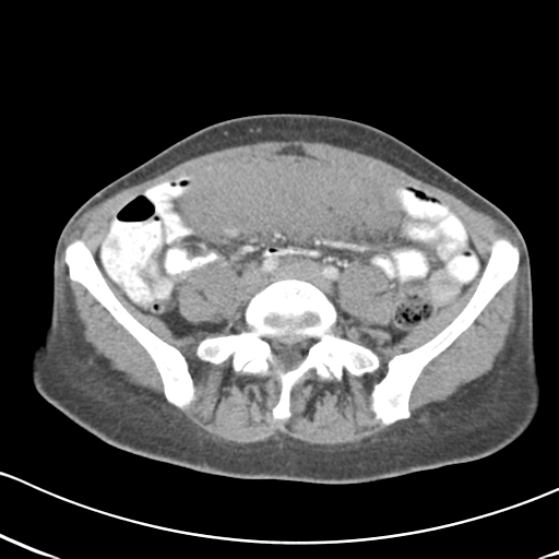 Abdominal desmoid tumor (Radiopaedia 41007-43740 Axial C+ portal venous phase 46).png
