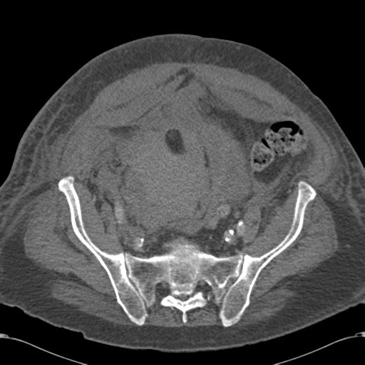 Abdominal hematoma (Radiopaedia 33614-34715 Axial C+ portal venous phase 98).png