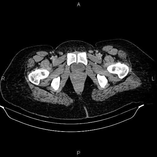 Abdominal lymphoma with sandwich sign (Radiopaedia 84378-99704 Axial C+ portal venous phase 59).jpg