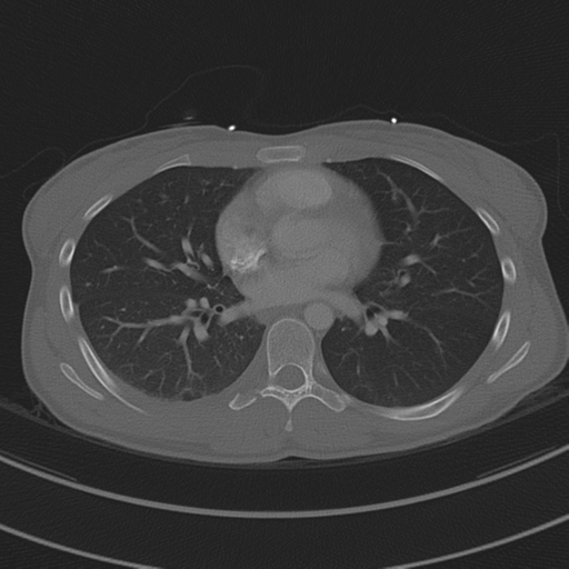 File:Abdominal multi-trauma - devascularised kidney and liver, spleen and pancreatic lacerations (Radiopaedia 34984-36486 I 48).png
