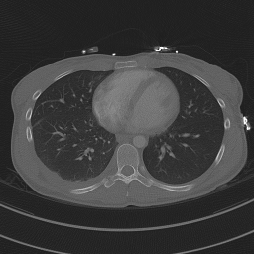 File:Abdominal multi-trauma - devascularised kidney and liver, spleen and pancreatic lacerations (Radiopaedia 34984-36486 I 56).png