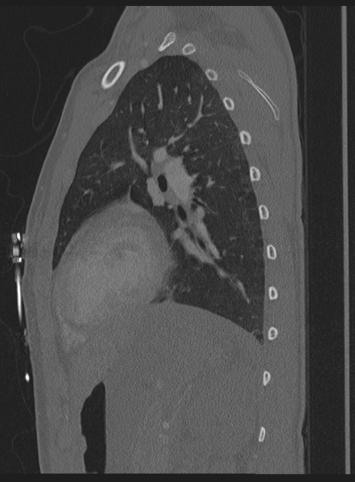 Abdominal multi-trauma - devascularised kidney and liver, spleen and pancreatic lacerations (Radiopaedia 34984-36486 Sagittal bone window 5).png