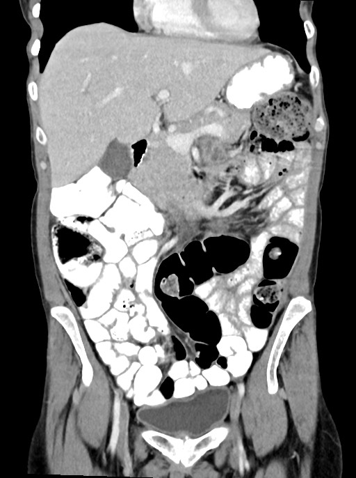 Abdominal wall and retroperitoneal tuberculosis (Radiopaedia 88137-104729 Coronal C+ portal venous phase 37).jpg
