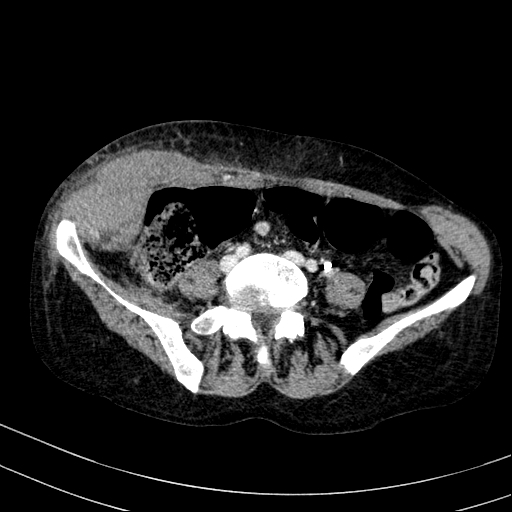 Abdominal wall hematoma with active bleeding (Radiopaedia 83915-99117 Axial C+ portal venous phase 81).jpg