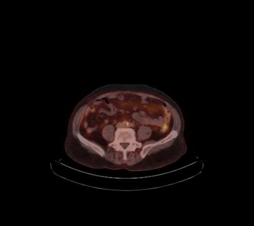 Abdominal wall metastasis from colorectal carcinoma (Radiopaedia 31016-31719 C 50).jpg