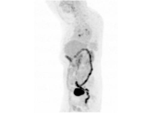 File:Abdominal wall metastasis from colorectal carcinoma (Radiopaedia 31016-31719 Rotational MIP 6).jpg