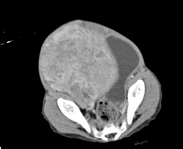 Abdominopelvic rhabdomyosarcoma (Radiopaedia 78356-90984 Axial C+ portal venous phase 135).jpg