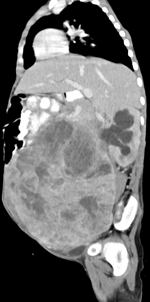 Abdominopelvic rhabdomyosarcoma (Radiopaedia 78356-90984 Sagittal C+ portal venous phase 60).jpg