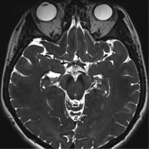 Abducens nerve palsy (Radiopaedia 51069-56648 Axial T2 fat sat 69).png
