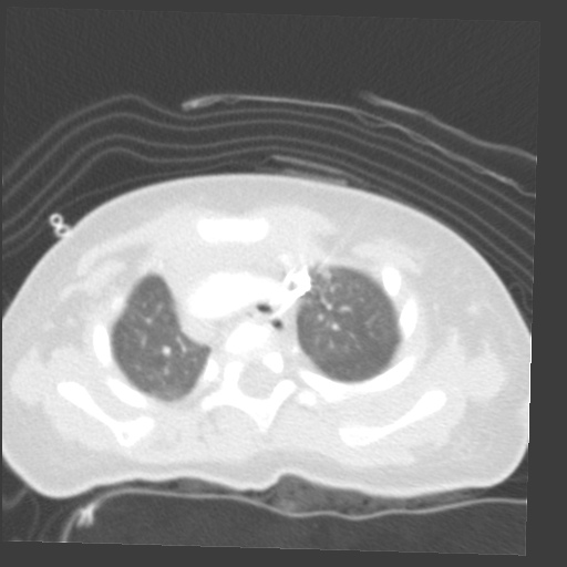 File:Aberrant left pulmonary artery (pulmonary sling) (Radiopaedia 42323-45435 Axial lung window 8).jpg