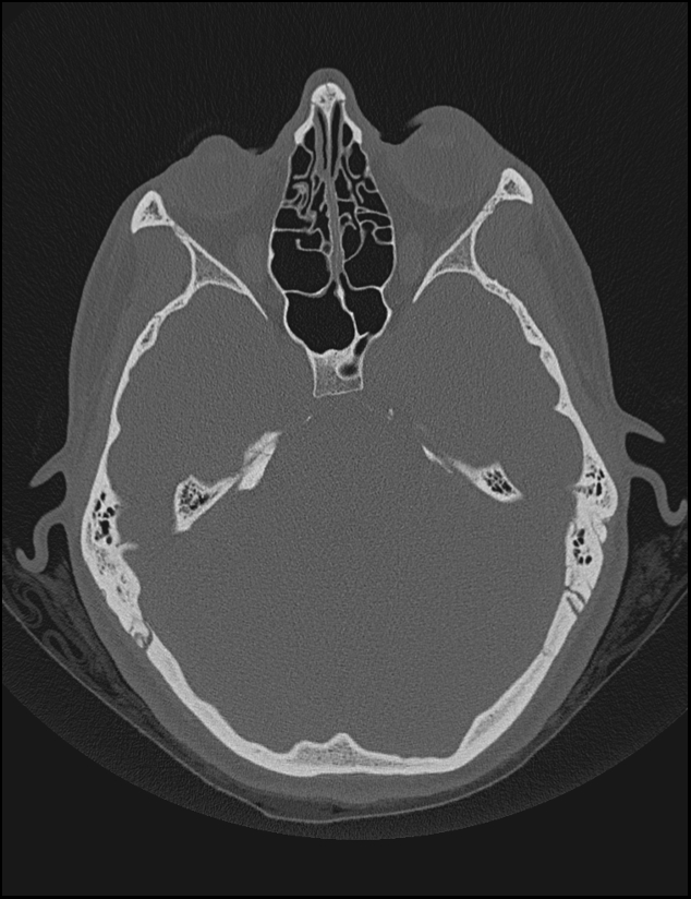 Aberrant right internal carotid artery (Radiopaedia 65191-74198 Axial non-contrast 59).jpg