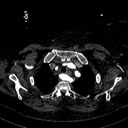 File:Aberrant right subclavian artery with Kommerell diverticulum (Radiopaedia 47982-52769 Axial C+ arterial phase 18).png