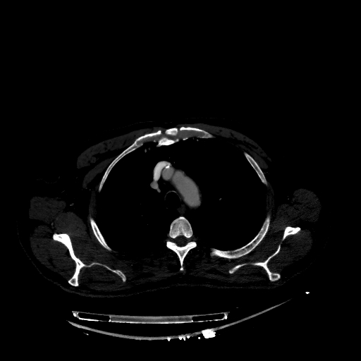 File:Accesory rib joint (Radiopaedia 71987-82452 Axial bone window 71).jpg
