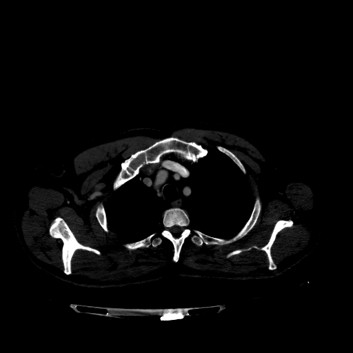 File:Accesory rib joint (Radiopaedia 71987-82452 Axial bone window 79).jpg
