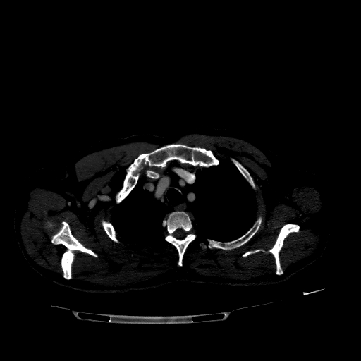 Accesory rib joint (Radiopaedia 71987-82452 Axial bone window 81).jpg