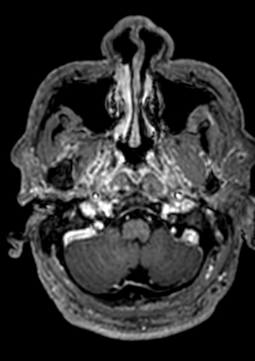 File:Accessory middle cerebral artery (Radiopaedia 73114-83828 Axial T1 C+ 168).jpg