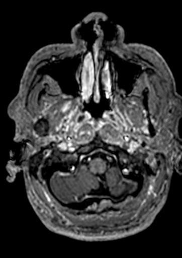 File:Accessory middle cerebral artery (Radiopaedia 73114-83828 Axial T1 C+ 177).jpg