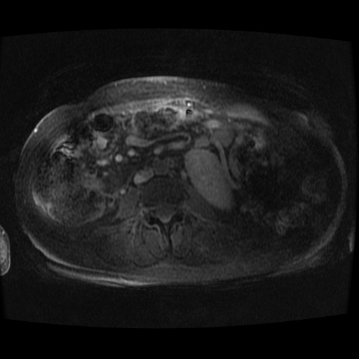 Acinar cell carcinoma of the pancreas (Radiopaedia 75442-86668 Axial late phase (~30 mins) 4).jpg