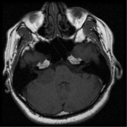 File:Acoustic schwannoma (Radiopaedia 33045-34060 Axial T1 7).png