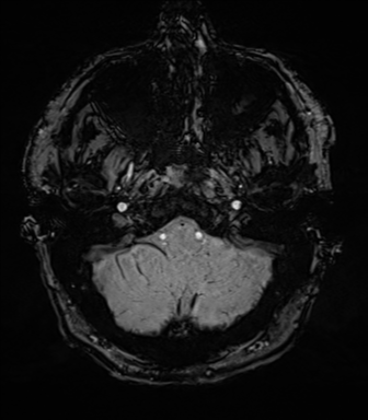 File:Acoustic schwannoma (Radiopaedia 50846-56358 Axial SWI 13).png